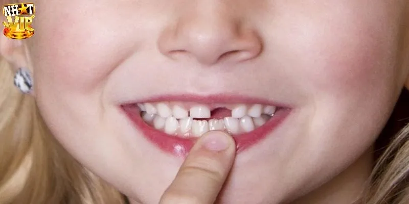 Mơ thấy răng rụng do bị tai nạn